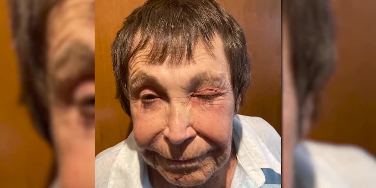 Comedian, 89, recovering after she was randomly punched, knocked to the ground [Video]